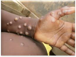 Monkeypox symptoms