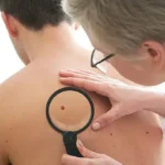 melanoma of skin cancer