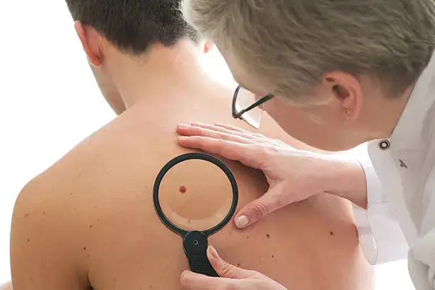 melanoma of skin cancer