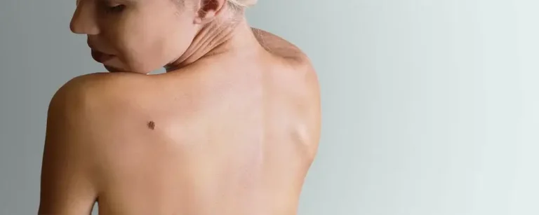 nodular melanoma​